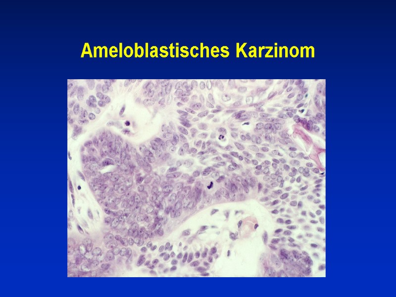 Ameloblastisches Karzinom